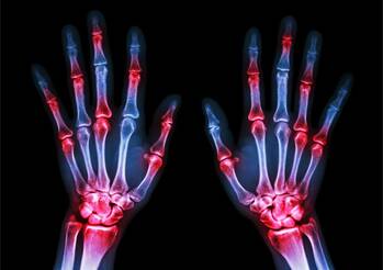 Revmatoidní artritida vám změní život