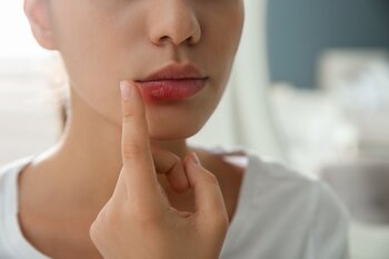 Trápí vás opary? Zjistěte, proč se vrací a jak s nimi účinně bojovat