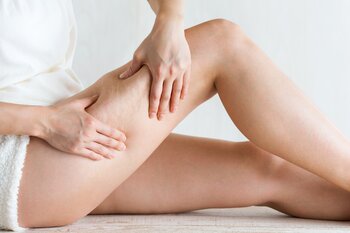 Trápí vás celulitida? Tyto tipy a triky vám pomohou k hladší pokožce