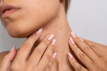 Jak na potničky: Nepříjemná letní vyrážka u dětí i dospělých